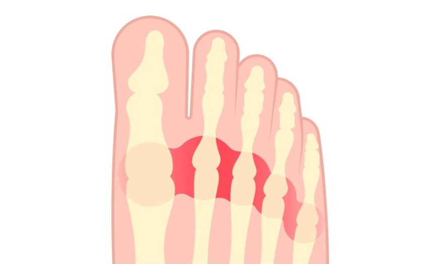 Metatarsalgi smarta framre transversella fotvalvet