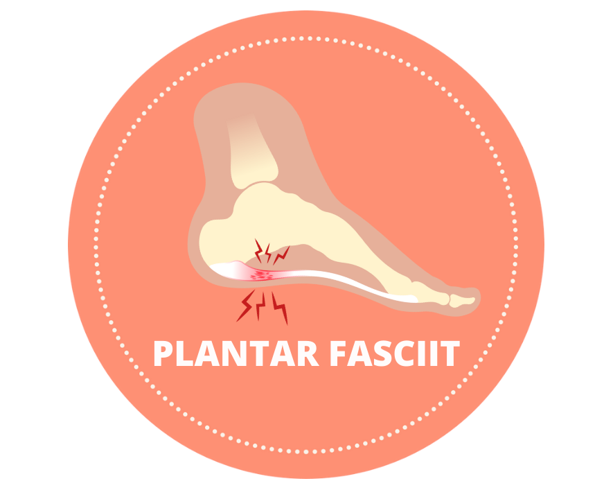 Plantar fasciit