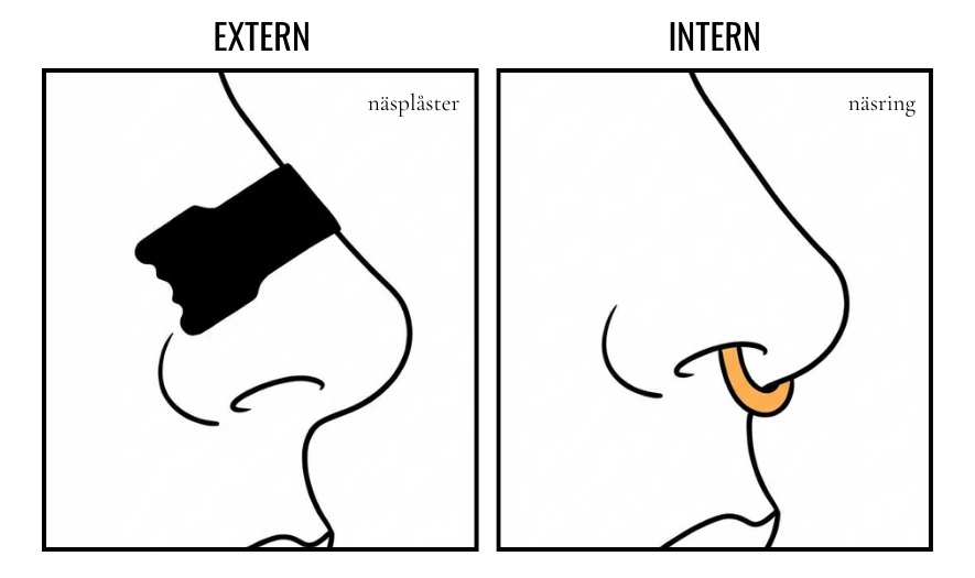 Illustration som visar extern näsvidgare till vänster (näsplåster) och intern näsvidgare till höger (näsring)